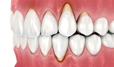 Gingivitis Before And After Treatment