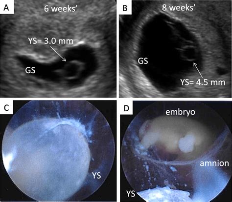 THE YOLK SAC* Yolk Ultrasound Guided Tips Facebook, 51% OFF