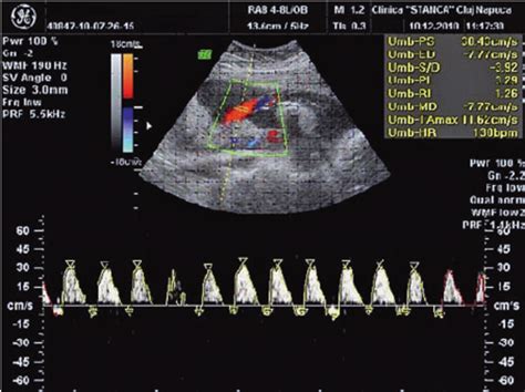 Umbilical Artery Ultrasound