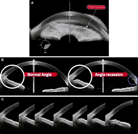 Imaging Angle Recession Using Anterior Segment OCT - Ophthalmology Glaucoma