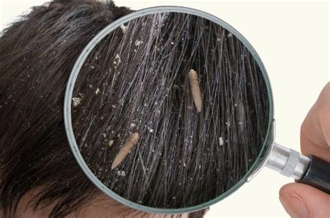 Dandruff Under the Microscope: Dandruff Symptoms and Causes?