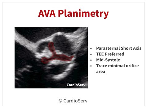 3 Additional Methods to Evaluating the AVA Cardioserv