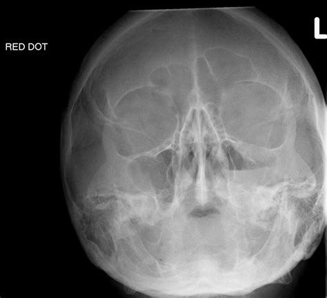 Zygomatic Arch Radiograph