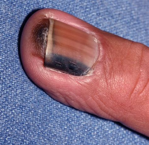 Nail Melanoma Symptoms - Nail Ftempo