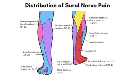 Sural Nerve Pain | Ease your Sural Nerve Pain