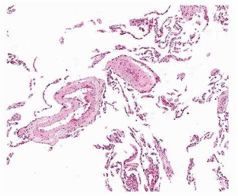 Panlobular Emphysema | Thoracic Key