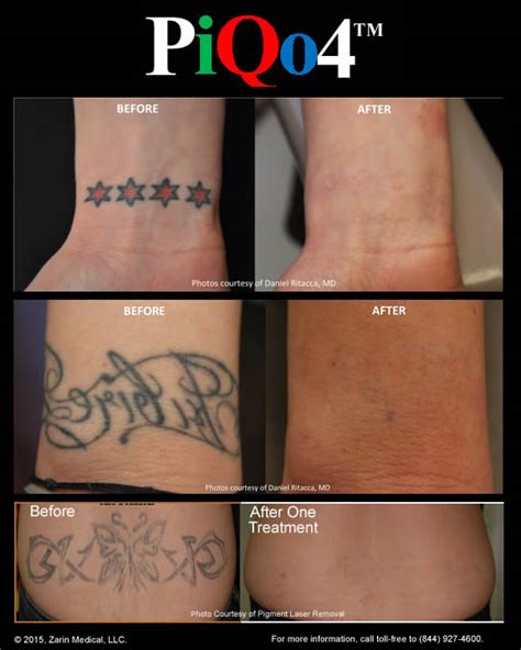 Tattoo Removal with Less Pain, 40% Fewer Treatments and Clearance of ...