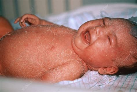 Staphylococcal Scalded Skin Syndrome - Stock Image - C043/0705 ...