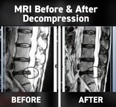 Minimally Invasive Lumbar Decompression | Solutions In Pain