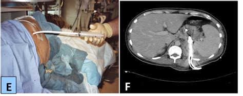 Minimally Invasive and Maximally Effective Approaches to Pancreatic Fluid Collections and ...