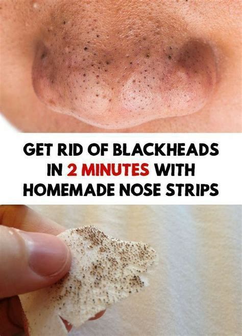 How To Get Rid Of Blackheads On Nose Permanently Home Remedies - HOWTOREMVO