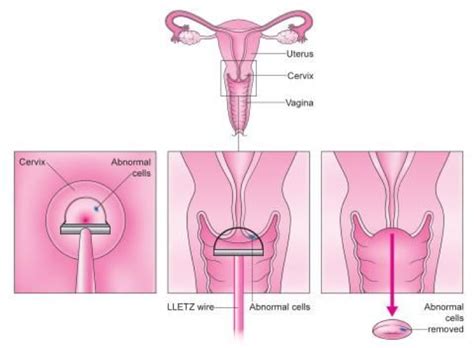 LLETZ Procedure to treat abnormal cervical cells - Dr. Nitu Bajekal