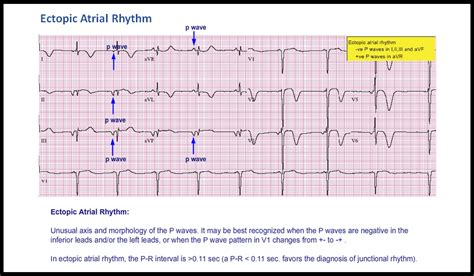 T29: Ectopic Atrial Rhythm - ECG Made Simple