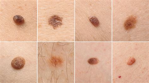 Understanding the different types of moles | Spot Check Clinic