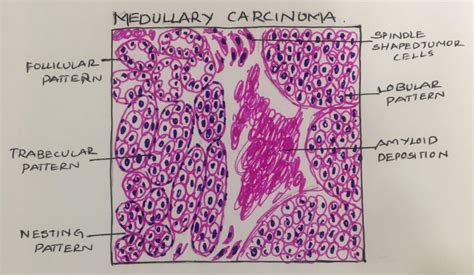 Medullary carcinoma thyroid – UG – Histopathology.guru