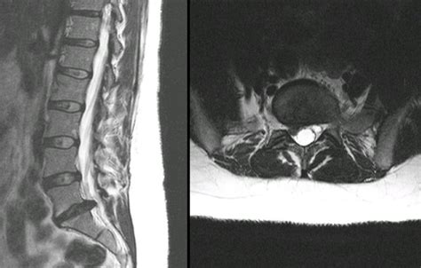 Herniated Lumbar Disc Mri