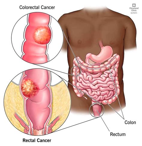 Rectal Cancer: What Is It, Signs, Stages & Treatment