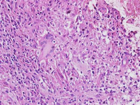 -Photomicrograph shows a granuloma surrounded by epithelioid... | Download Scientific Diagram