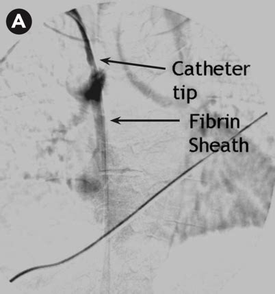 Hemodialysis Catheter Complications (And What To Do About Them) - Renal ...