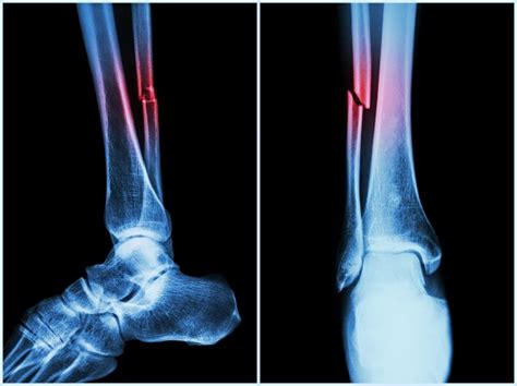 10 Facts You Must Know about Bone Fractures