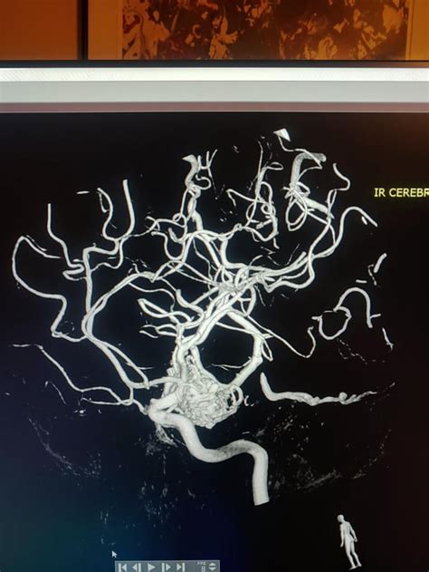 AVM surgery guidance : r/AVMs