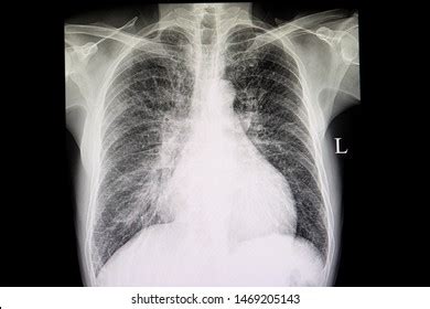 Chest Xray Film Patient Congestive Heart Stock Photo 1469205143 ...