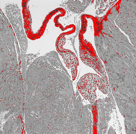 Columbia Researchers Uncover Dangerous Connection Between Serotonin and Heart Valve Disease