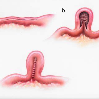 Heineke-Mikulicz strictureplasty. a The stricture is divided along the ...