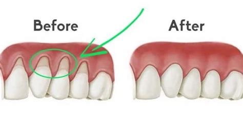 Recovery after gum graft surgery: tips to speed healing - missionimplantcenter