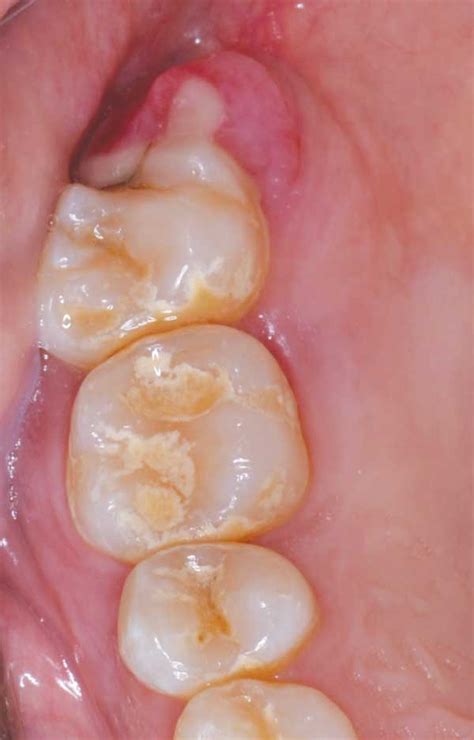 An Unusual Presentation of Peripheral Ossifying Fibroma - Decisions in ...