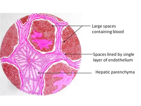 Cavernous Hemangioma - Pathology Made Simple