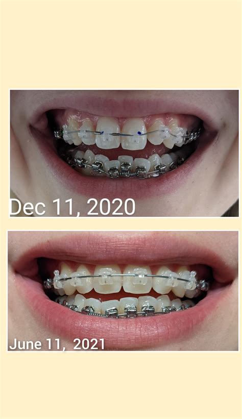 6 month progress pic! : r/braces