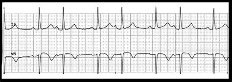 EKG Rhythm Quiz 221