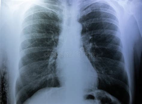 X Ray Image of a Human Chest Stock Photo - Image of exam, health: 262599904