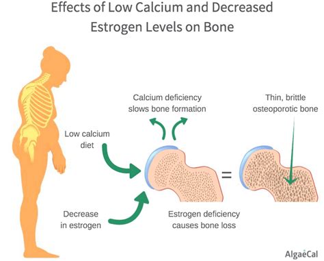 Postmenopausal Osteoporosis: Everything You Need to Know