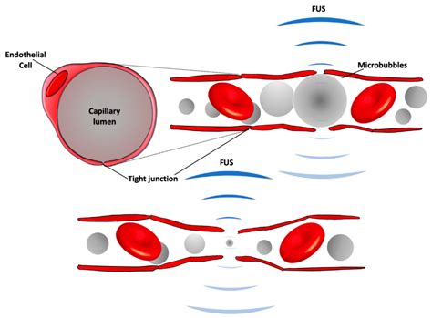 Pharmaceutics | Free Full-Text | Focused Ultrasound and Microbubbles ...