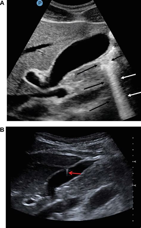 [PDF] Artifacts in diagnostic ultrasound | Semantic Scholar