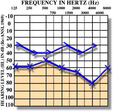 Audiograms & Hearing Loss - DHH Education