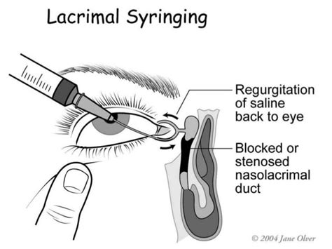 Lacrimal Syringing, Procedure, Result, Indication and Contraindications ...