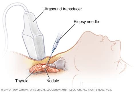 Thyroid Cancer Biopsy