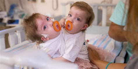 Rare conjoined twins, born locked in embrace, successfully separated in ...