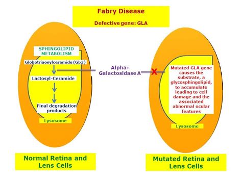 A deficiency of alpha-galactosidase A due to mutations in the GLA gene is responsible for Fabry ...