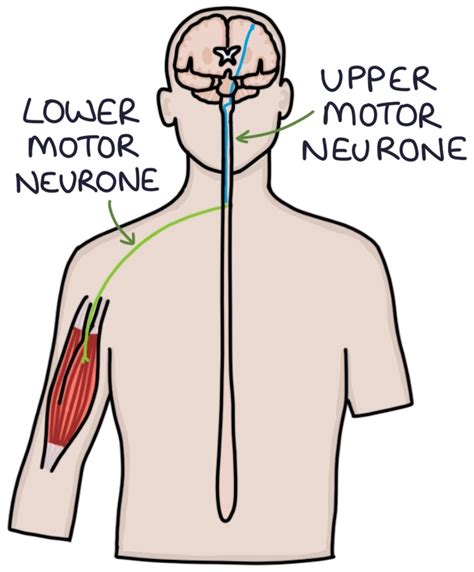 Upper Vs Lower Motor Neuron Signs