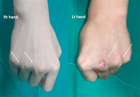 Frontiers | Treatment of bilateral congenital extensor tendon dislocation on multiple digits ...