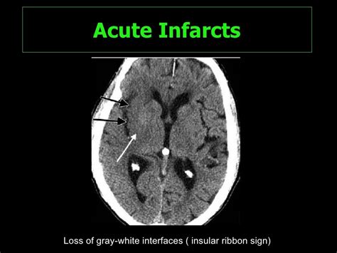 Cerebral Ischemia