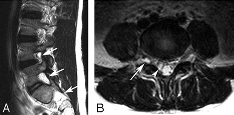 Mri Lumbar Spine Nerve Roots