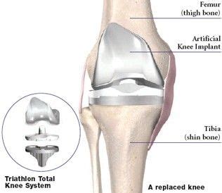 Pin on Stryker Knee Replacement photo & video