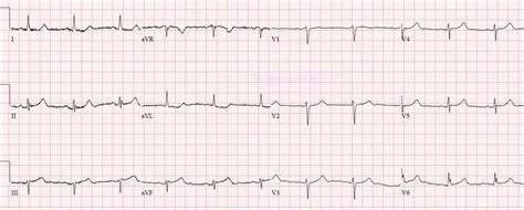 Subtle Inferior MI | ECG cases | EM cases