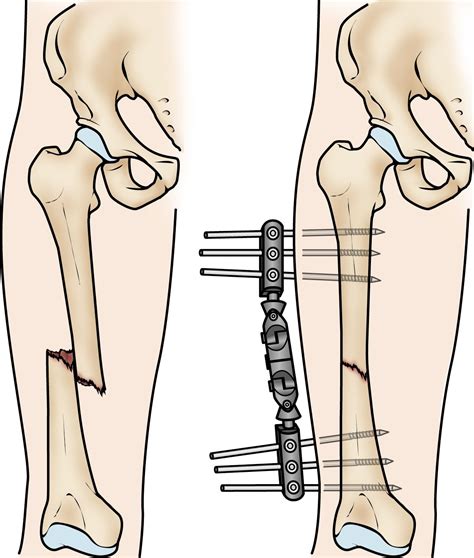 Closed Femur Fracture