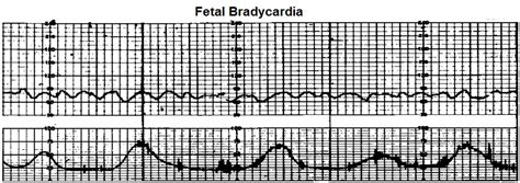 Fetal Bradycardia